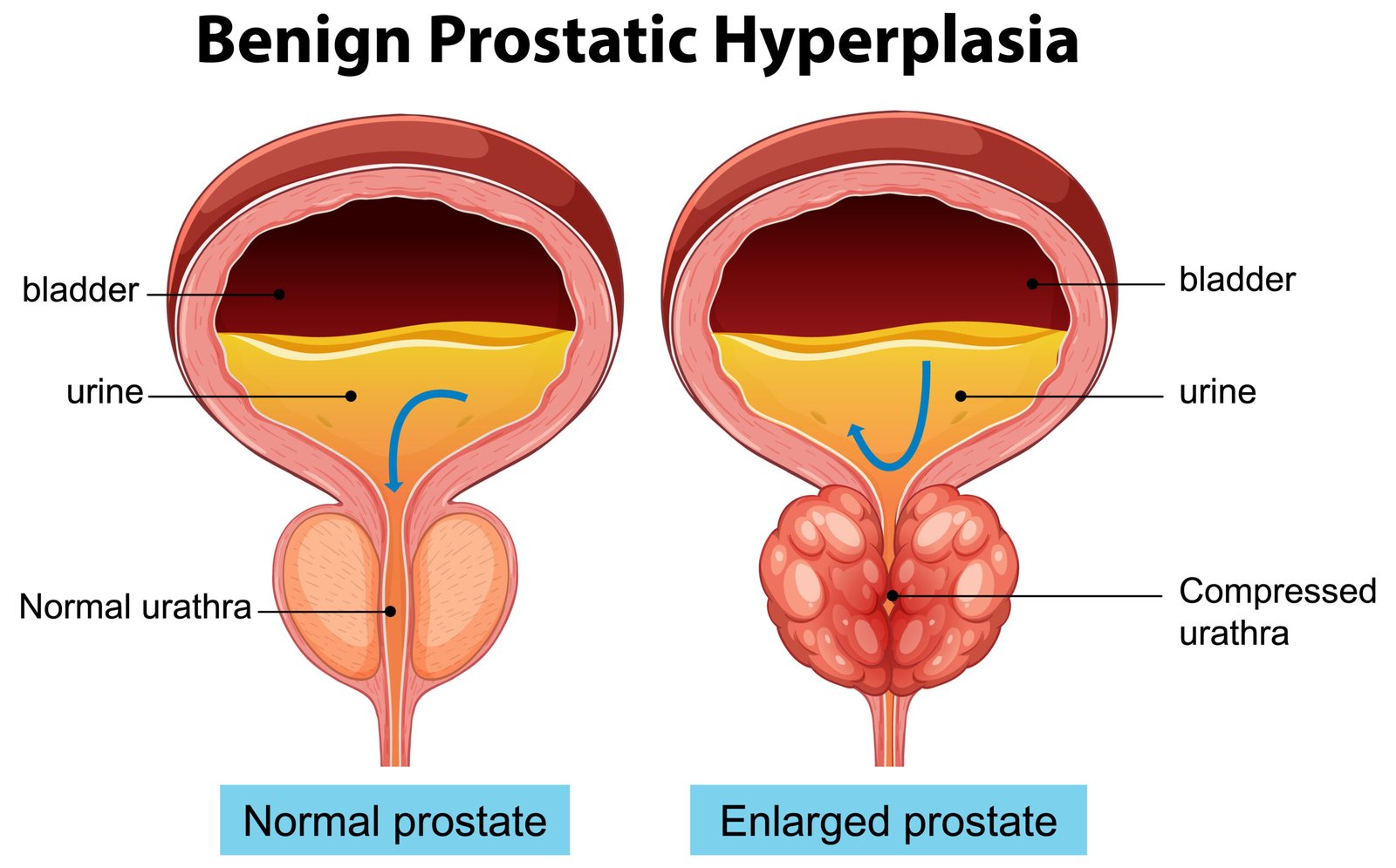 Normal Prostate vs Enlarged Prostate: Understanding the Difference